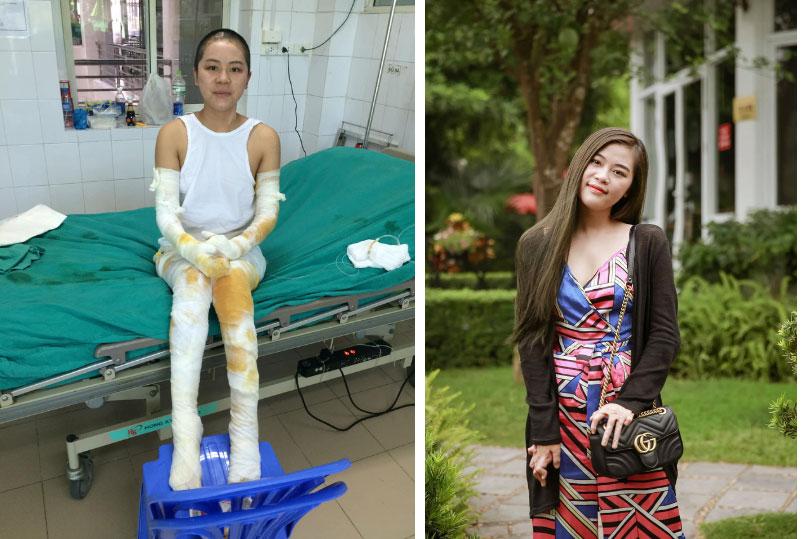 Gặp cô giáo xinh đẹp bị bỏng nặng do nổ bóng bay: Mình vẫn đang sống và càng phải sống mạnh mẽ hơn bất cứ lúc nào-1