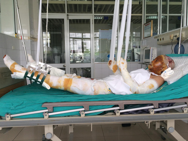 Gặp cô giáo xinh đẹp bị bỏng nặng do nổ bóng bay: Mình vẫn đang sống và càng phải sống mạnh mẽ hơn bất cứ lúc nào-2