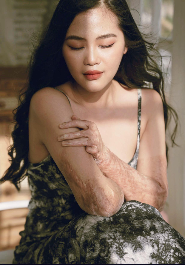 Gặp cô giáo xinh đẹp bị bỏng nặng do nổ bóng bay: Mình vẫn đang sống và càng phải sống mạnh mẽ hơn bất cứ lúc nào-3