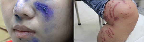 TP.HCM: Báo động bỏng, viêm da do kiến ba khoang-1