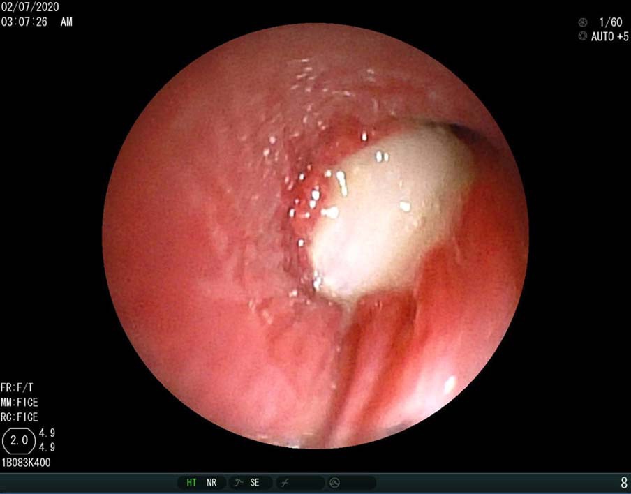 Đi nhổ răng sâu, bé gái bị tắc đường thở sau khi... răng biến mất?-1
