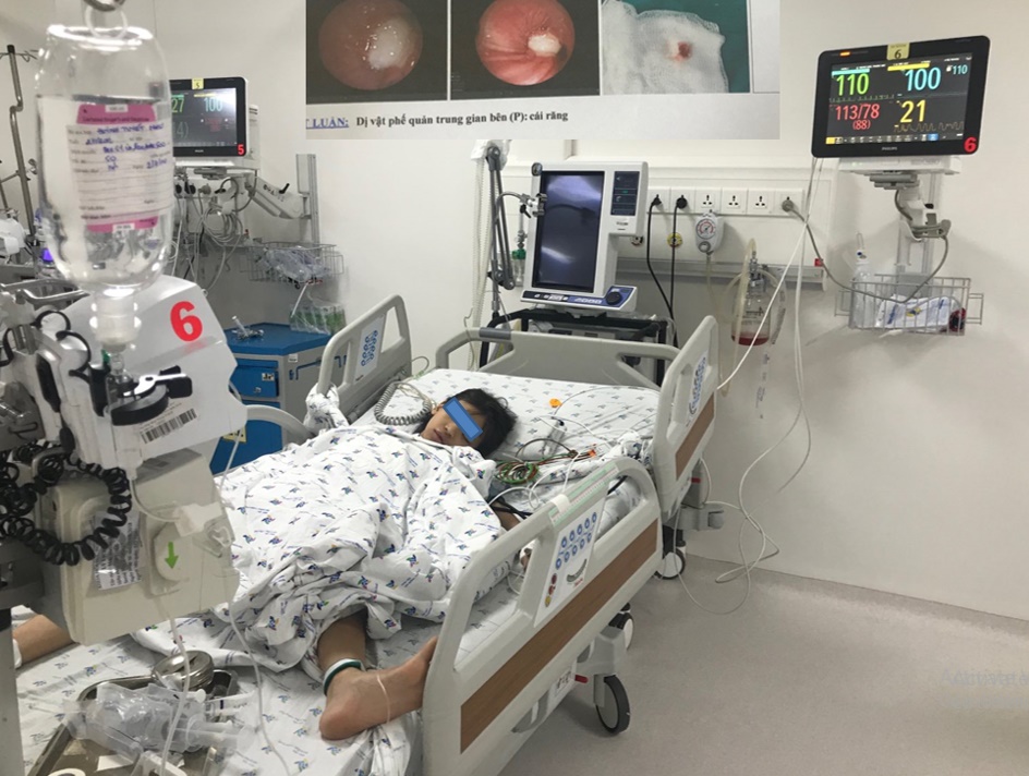 Đi nhổ răng sâu, bé gái bị tắc đường thở sau khi... răng biến mất?-2