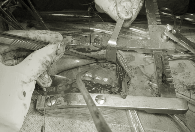 Bé trai 9 tuổi nghi bị mẹ dùng kéo đâm thủng tim đã có thể ăn uống, không dám kể lại sự việc vì sợ-3