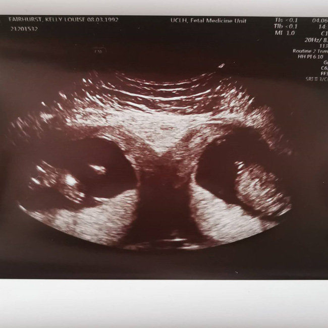 Kỳ lạ mẹ bầu mang song thai, nhưng là trong 2 tử cung khác nhau-1