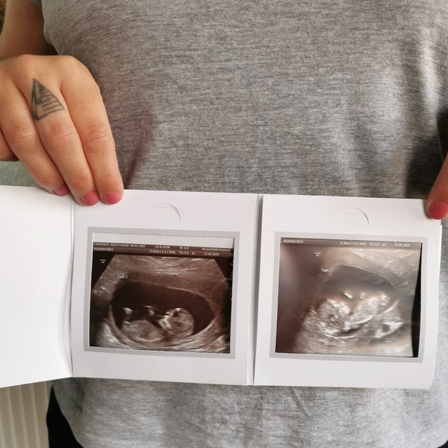 Kỳ lạ mẹ bầu mang song thai, nhưng là trong 2 tử cung khác nhau-2