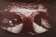 Kỳ lạ mẹ bầu mang song thai, nhưng là trong 2 tử cung khác nhau