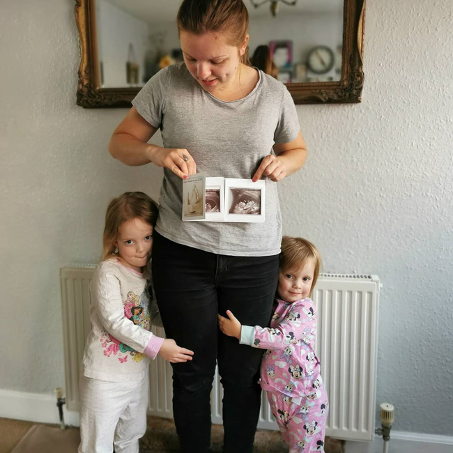 Kỳ lạ mẹ bầu mang song thai, nhưng là trong 2 tử cung khác nhau-3