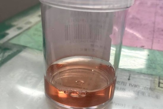 Nhiều trẻ đến viện vì đi 