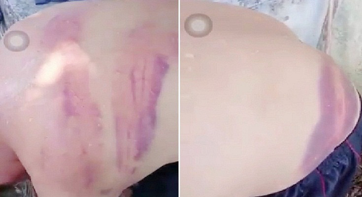 Xác minh vụ người đàn ông bầm tím khắp lưng nghi bị vợ hờ đánh ở Nghệ An-1