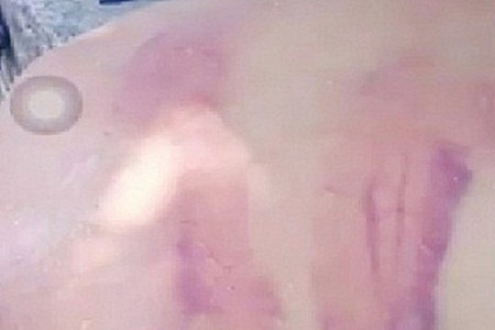 Xác minh vụ người đàn ông bầm tím khắp lưng nghi bị 