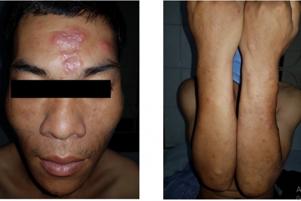 Bệnh phong: Căn bệnh tưởng chừng bị lãng quên lại tái xuất-1