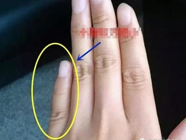 Rất Hay: Nốt ruồi ở ngón tay áp út mang ý nghĩa gì? Ảnh hưởng ra sao?