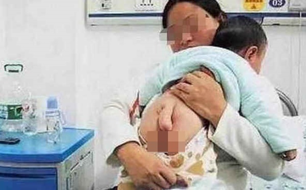 Hội chứng khiến bé trai 6 tháng tuổi mọc đuôi 5cm, em bé 11 tháng tuổi có đuôi dài 15cm và ngày càng dài-1