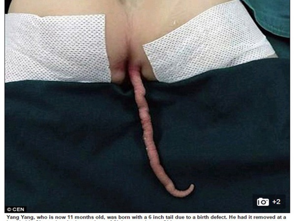 Hội chứng khiến bé trai 6 tháng tuổi mọc đuôi 5cm, em bé 11 tháng tuổi có đuôi dài 15cm và ngày càng dài-2