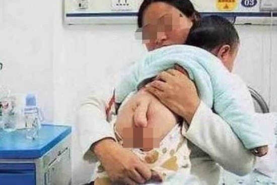 Hội chứng khiến bé trai 6 tháng tuổi