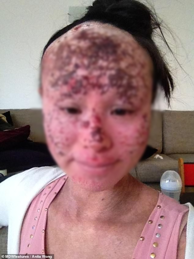 Một người phụ nữ sốc nặng khi nghe mình bị đục thủy tinh thể đến mức hỏng mắt phải vĩnh viễn vì một loại kem bôi ngoài da-2