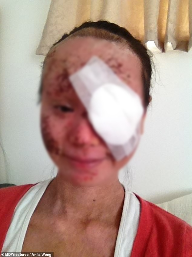Một người phụ nữ sốc nặng khi nghe mình bị đục thủy tinh thể đến mức hỏng mắt phải vĩnh viễn vì một loại kem bôi ngoài da-4