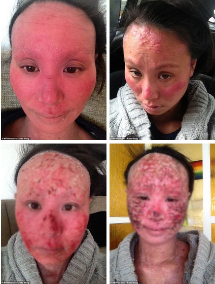 Một người phụ nữ sốc nặng khi nghe mình bị đục thủy tinh thể đến mức hỏng mắt phải vĩnh viễn vì một loại kem bôi ngoài da-5