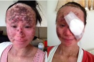 Một người phụ nữ sốc nặng khi nghe mình bị đục thủy tinh thể đến mức hỏng mắt phải vĩnh viễn vì một loại kem bôi ngoài da
