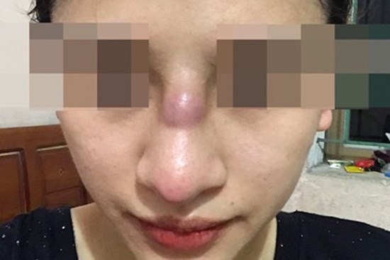 Cô gái 19 tuổi nhiễm trùng mũi sau khi làm đẹp ở spa
