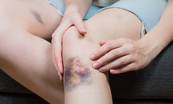 Khi nào sốt, chảy máu mũi là dấu hiệu trẻ mắc ung thư?-2