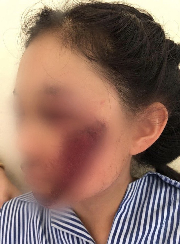 Áo chống nắng cuốn vào bánh xe khiến nữ sinh tổn thương mặt nghiêm trọng-1