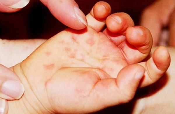 Bệnh tay chân miệng gia tăng, nhiều trẻ sốt cao không xác định nguồn lây, bố mẹ nên nhận diện bệnh để tránh nhầm lẫn với các bệnh ngoài da khác-3