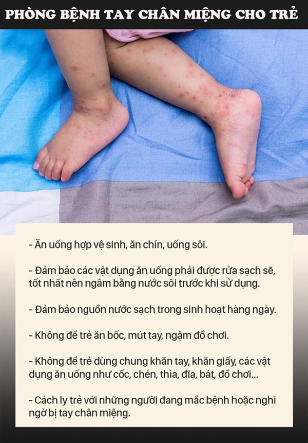 Bệnh tay chân miệng gia tăng, nhiều trẻ sốt cao không xác định nguồn lây, bố mẹ nên nhận diện bệnh để tránh nhầm lẫn với các bệnh ngoài da khác-4
