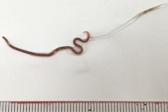 Bác sĩ gắp ra một con giun 38mm từ amidan của một phụ nữ, nguyên nhân là do cô đã ăn món ăn phổ biến nhiều người thích