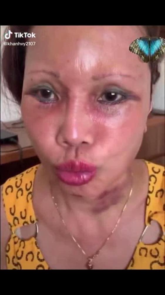 3 tuần sau dao kéo, cô dâu 63 tuổi ở Cao Bằng miệng méo đáng thất vọng-2