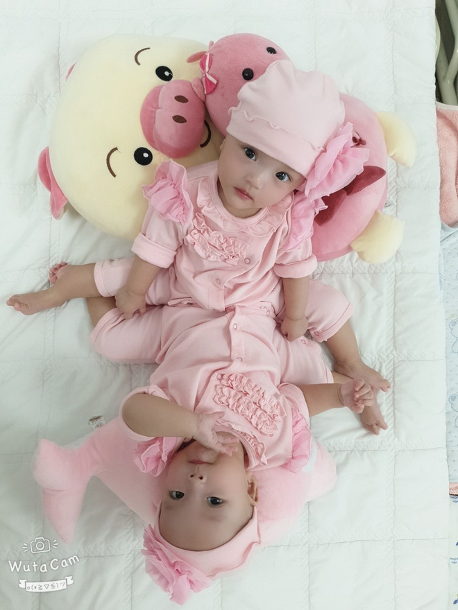 Sẵn sàng cho ca mổ tách dính 2 bé gái dùng chung một bỉm tại BV Nhi Đồng TP.HCM-4