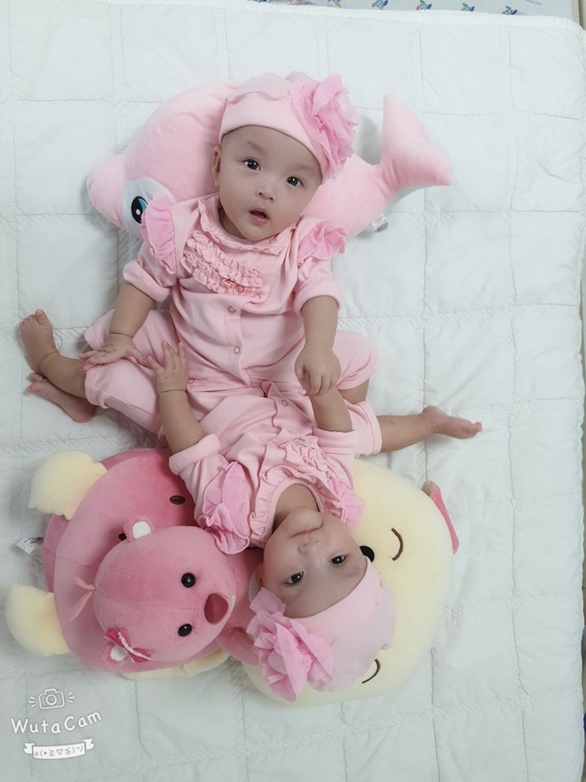 Sẵn sàng cho ca mổ tách dính 2 bé gái dùng chung một bỉm tại BV Nhi Đồng TP.HCM-5