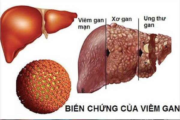 Hy vọng mới trong điều trị viêm gan, xơ gan ở BV Thu Cúc-1