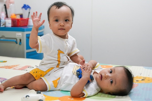 Mẹ 2 bé gái song sinh dính nhau nghẹn ngào mong con bình an trước khi bước vào ca mổ sinh tử-11