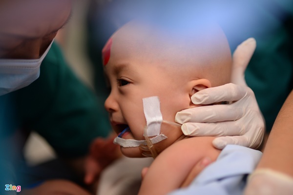 100 y bác sĩ làm gì trong phòng mổ tách song sinh dính liền?-2