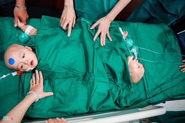 100 y bác sĩ làm gì trong phòng mổ tách song sinh dính liền?-4