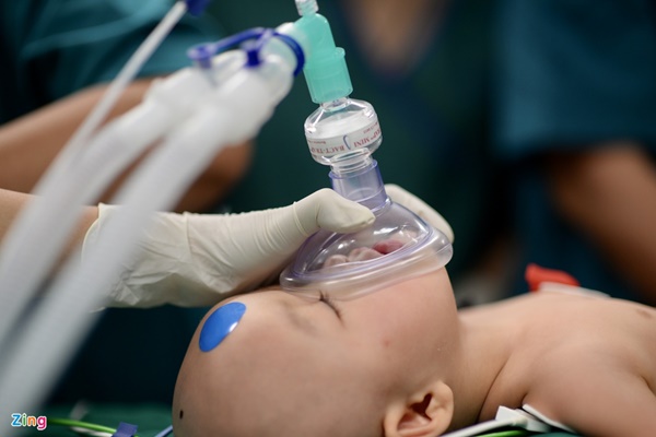 100 y bác sĩ làm gì trong phòng mổ tách song sinh dính liền?-7