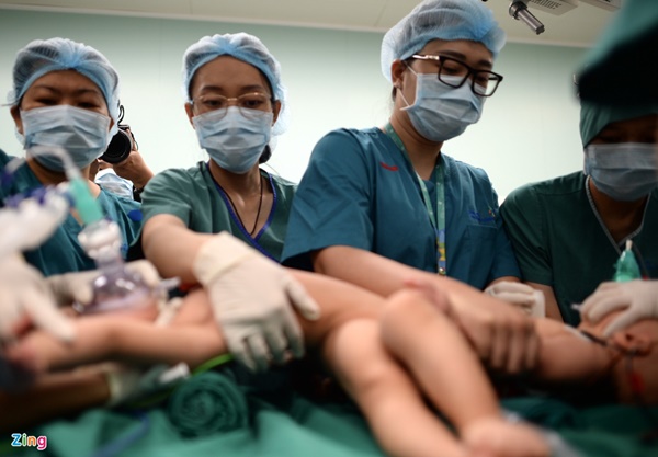 100 y bác sĩ làm gì trong phòng mổ tách song sinh dính liền?-8