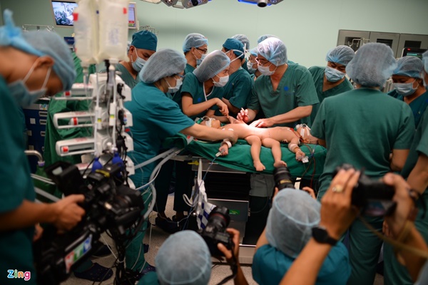 100 y bác sĩ làm gì trong phòng mổ tách song sinh dính liền?-9