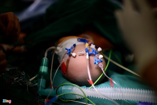 100 y bác sĩ làm gì trong phòng mổ tách song sinh dính liền?-10