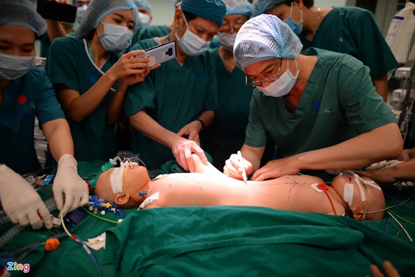 100 y bác sĩ làm gì trong phòng mổ tách song sinh dính liền?-13