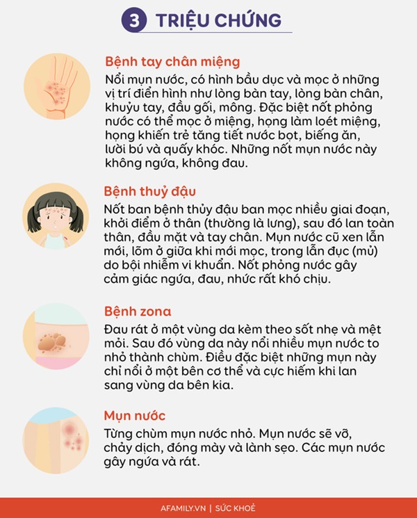 Phân biệt bệnh TAY CHÂN MIỆNG với một số bệnh có biểu hiện tương tự dễ gây nhầm lẫn như thủy đậu, zona, mụn nước-2