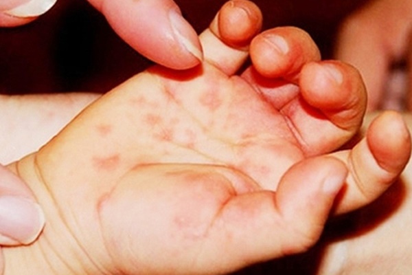 Hàng loạt trẻ bị tay chân miệng nhưng thuốc điều trị đã hết-4