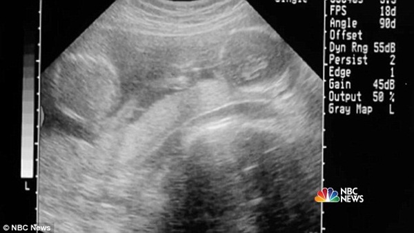 2 con gái sinh đôi dính liền, cha mẹ mất 7 tháng mới quyết định tách rời con, 17 năm sau ai cũng mãn nguyện khi thấy nụ cười của các em-1