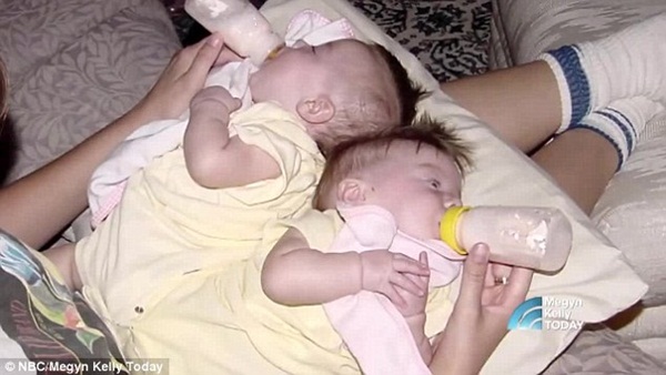 2 con gái sinh đôi dính liền, cha mẹ mất 7 tháng mới quyết định tách rời con, 17 năm sau ai cũng mãn nguyện khi thấy nụ cười của các em-3