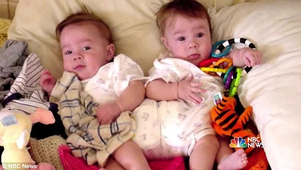 2 con gái sinh đôi dính liền, cha mẹ mất 7 tháng mới quyết định tách rời con, 17 năm sau ai cũng mãn nguyện khi thấy nụ cười của các em-4