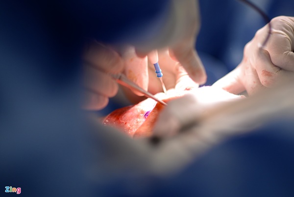 Tách thành công cặp song sinh dính liền-2