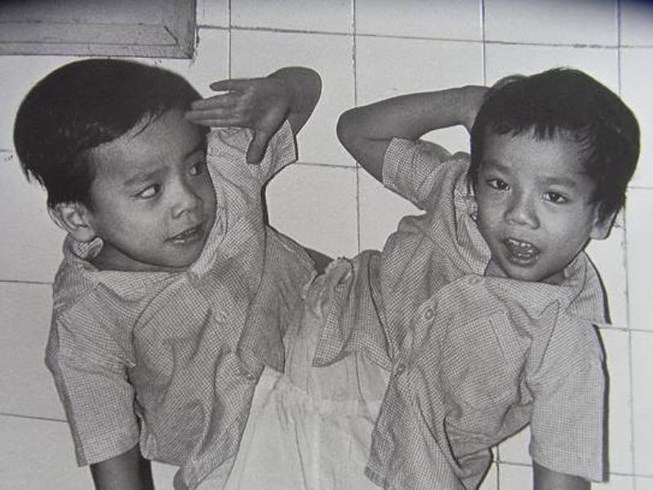 30 năm ngày tách rời cặp song sinh Việt - Đức đi vào lịch sử-1