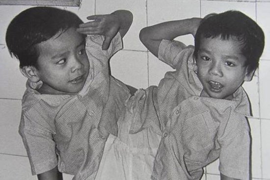 30 năm ngày tách rời cặp song sinh Việt - Đức đi vào lịch sử