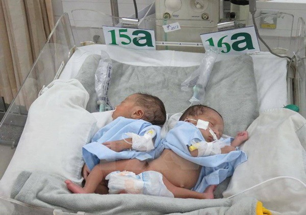 Những ca phẫu thuật tách rời song sinh đình đám của Việt Nam-2